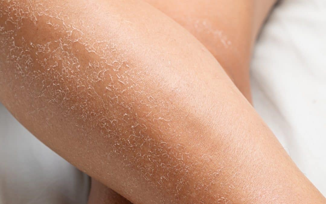 Kako se riješiti suhe kože zimi