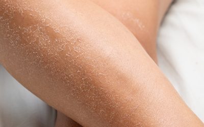 Kako se riješiti suhe kože zimi